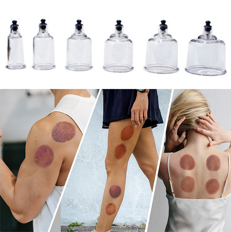 ชุดถ้วยบำบัด17กระป๋องเครื่องนว - Cupping Therapy Set บทวิจารณ์และราคา
