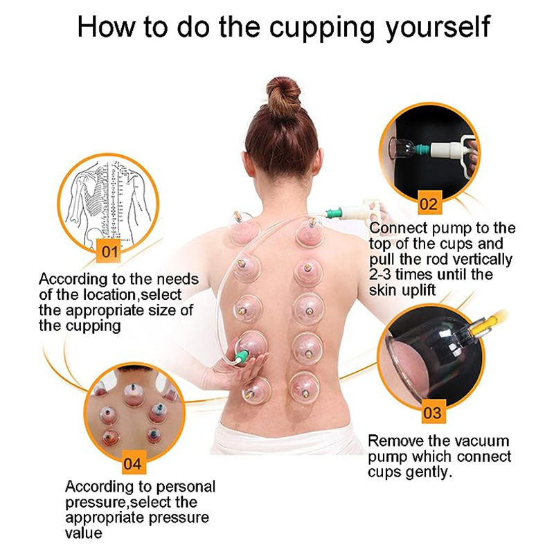 ชุดถ้วยครอบแก้วสุญญากาศจีน JIN - Cupping Therapy Set บทวิจารณ์และราคา