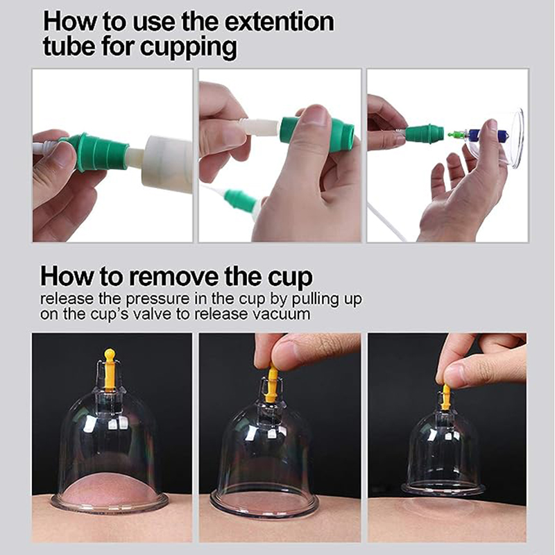 ชุดถ้วยครอบแก้วสุญญากาศจีน JIN - Cupping Therapy Set บทวิจารณ์และราคา